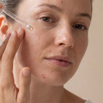 Recette de soin local anti-boutons aux huiles essentielles