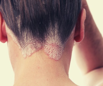Soigner l’eczéma avec des huiles essentielles