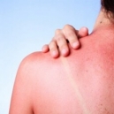 Coups de soleil et huiles essentielles: Soulager et traiter Coups de soleil et huiles essentielles: Soulager et traiter