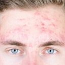 Les huiles essentielles contre l’acné et les boutons - traitement naturel Les huiles essentielles contre l’acné et les boutons - traitement naturel