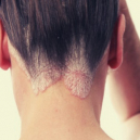Soigner l'eczéma avec des huiles essentielles Soigner l'eczéma avec des huiles essentielles